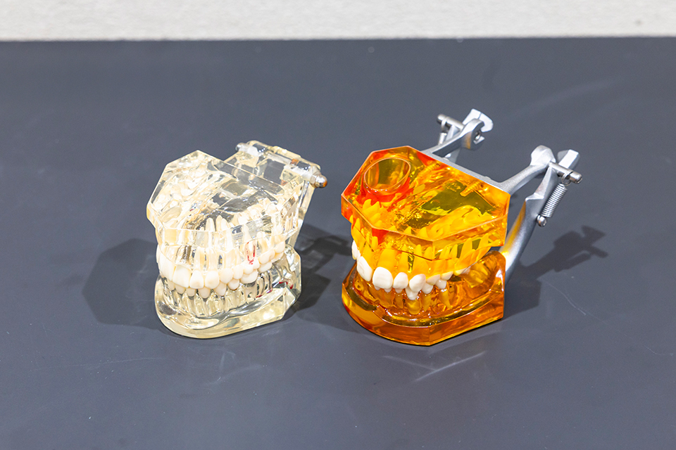 銀歯から白い歯への変更