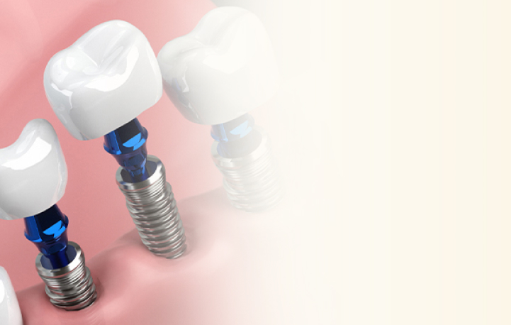 インプラント治療