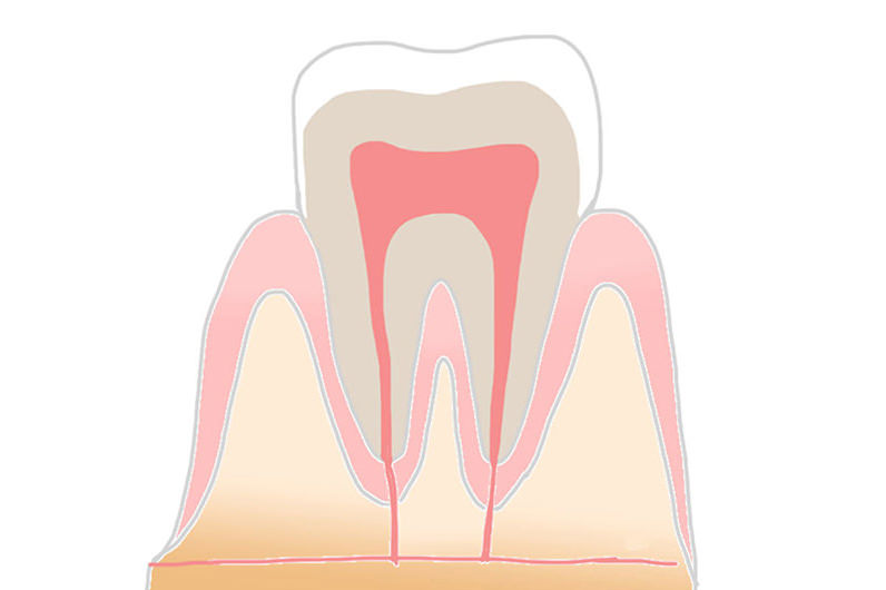 ごく初期のむし歯